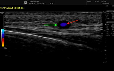 Evolution of ultrasound in giant cell arteritis